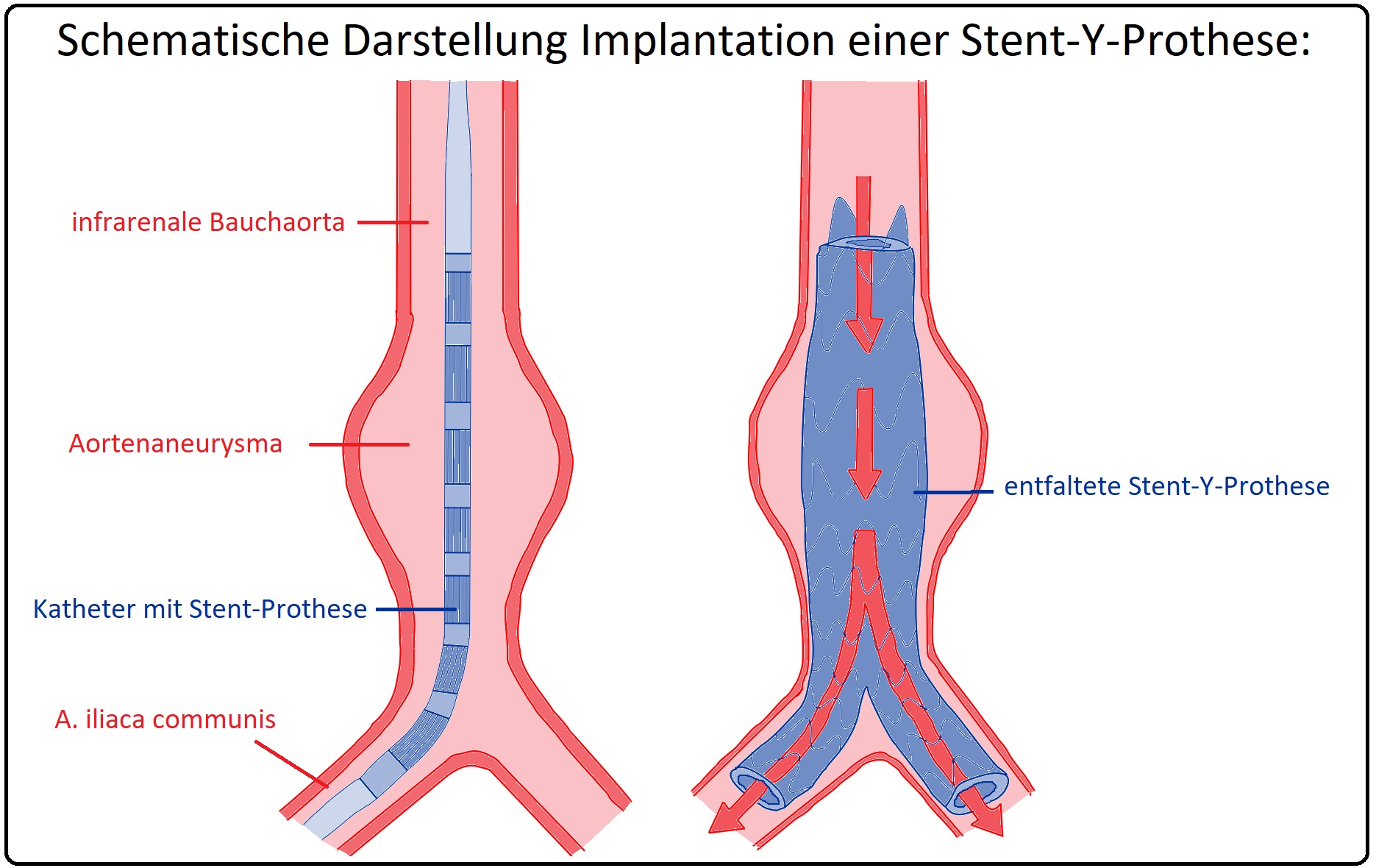 645 Schematische Darstellung der Implantation einer Stent Y Prothese