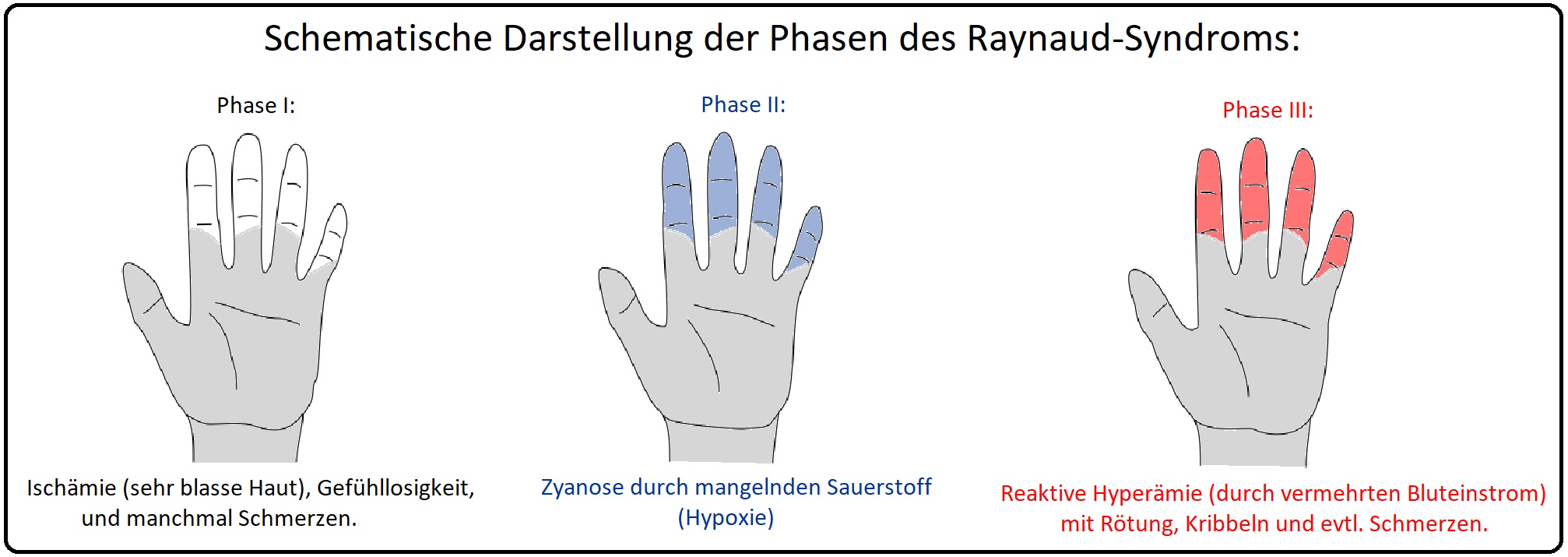 816 Schematische Darstellung der Phasen des Raynaud Syndroms