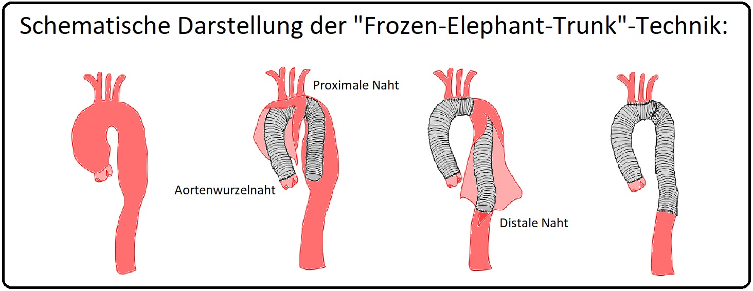 818 Schematische Darstellung der Frozen Elephant Trunk Technik