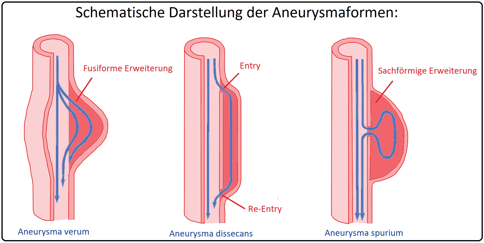 Schematische Darstellung der Aneurysmaformen