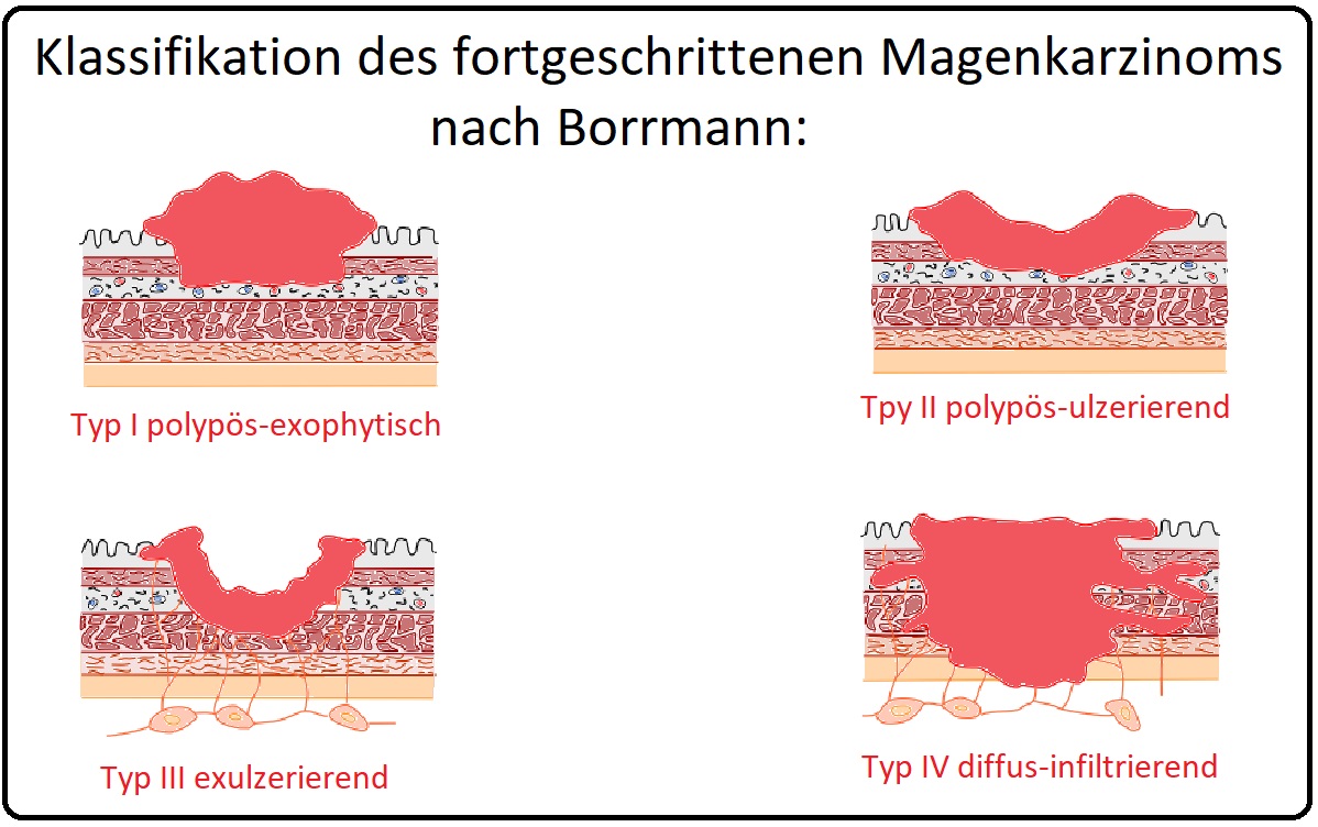 1175 Klassifikation des fortgeschrittenen Magenkarzinoms nach Borrmann