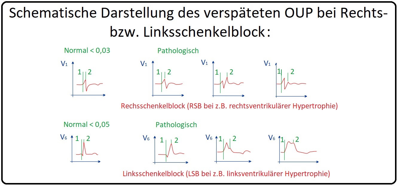 1074 Schematische Darstellung des verspäteten OUP bei Rechts  und Linksschenkelblock