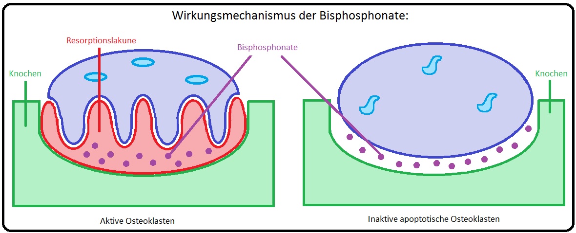 087 Wirkungsmechanismus der Bisphosphonate