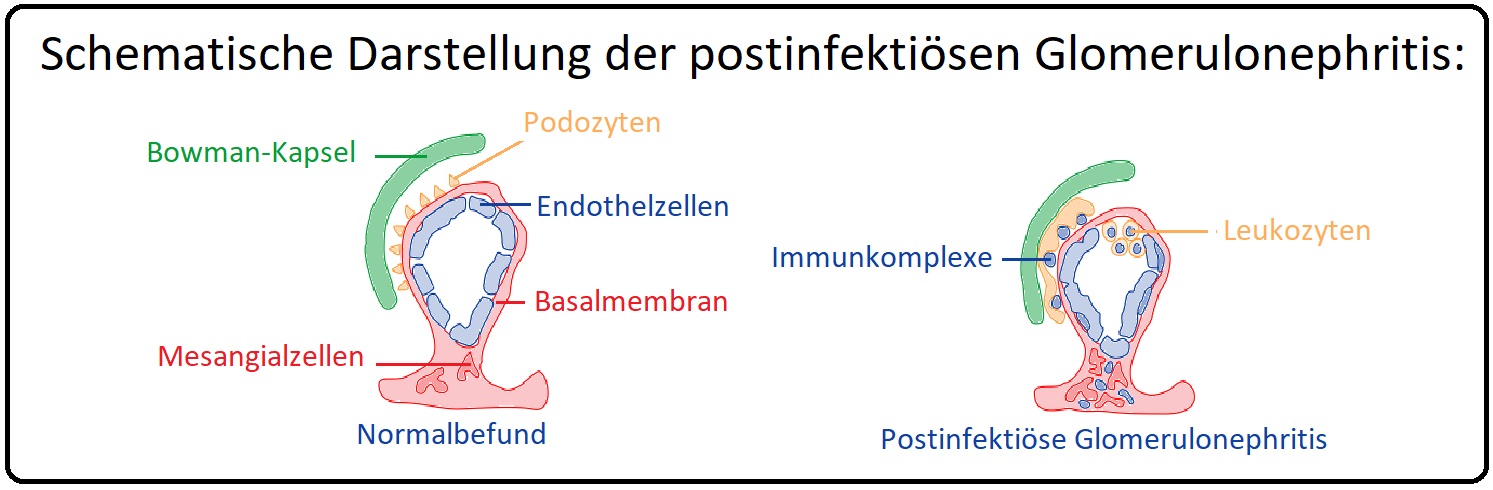 1121 Schematische Darstellung der postinfektiösen Glomerulonephritis