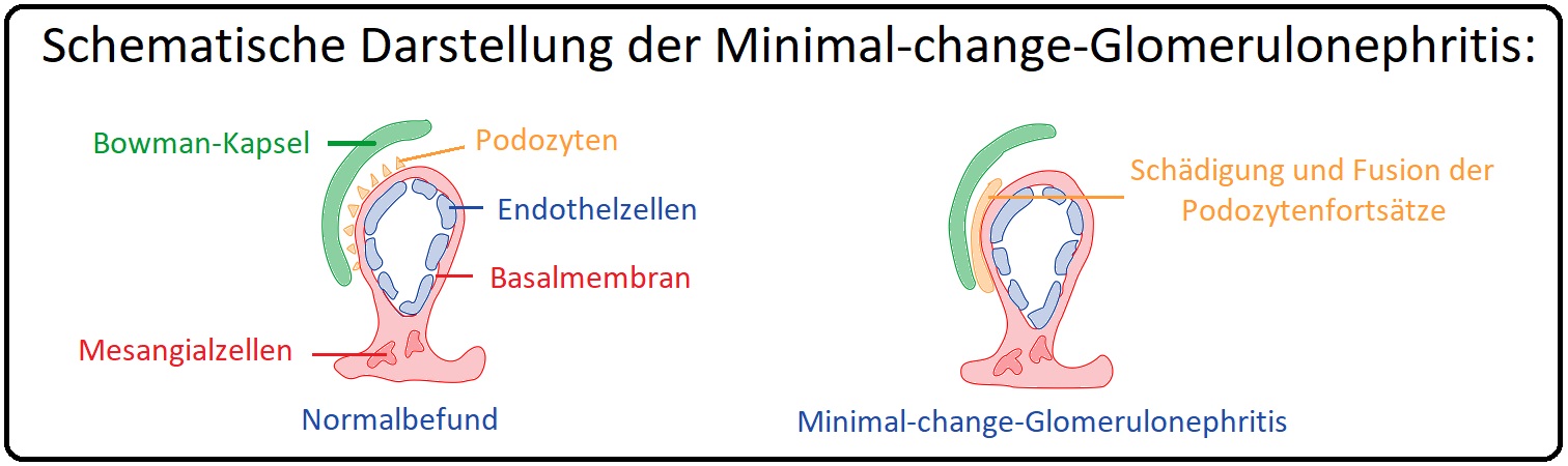 1122 Schematische Darstellung der Minimal change Glomerulonephritis