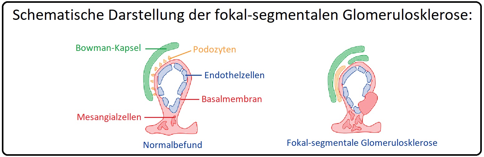 1129 Schematische Darstellung der fokal segmentealen Glomerulosklerose
