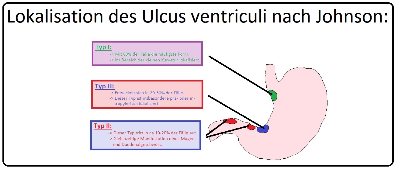 575 Lokalisation des Ulcus ventriculi nach Johnson