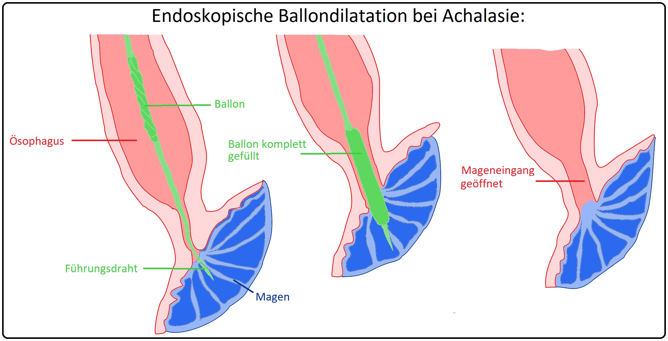 578 Endoskopische Ballondilatation bei Achalasie