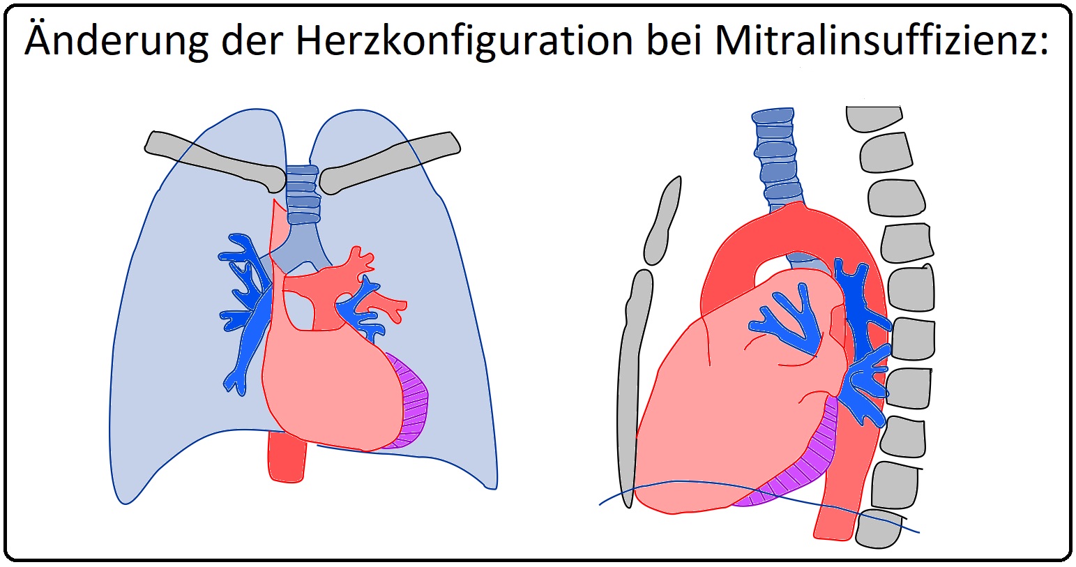 628 Änderung der Herzkonfiguration bei Mitralinsuffizienz