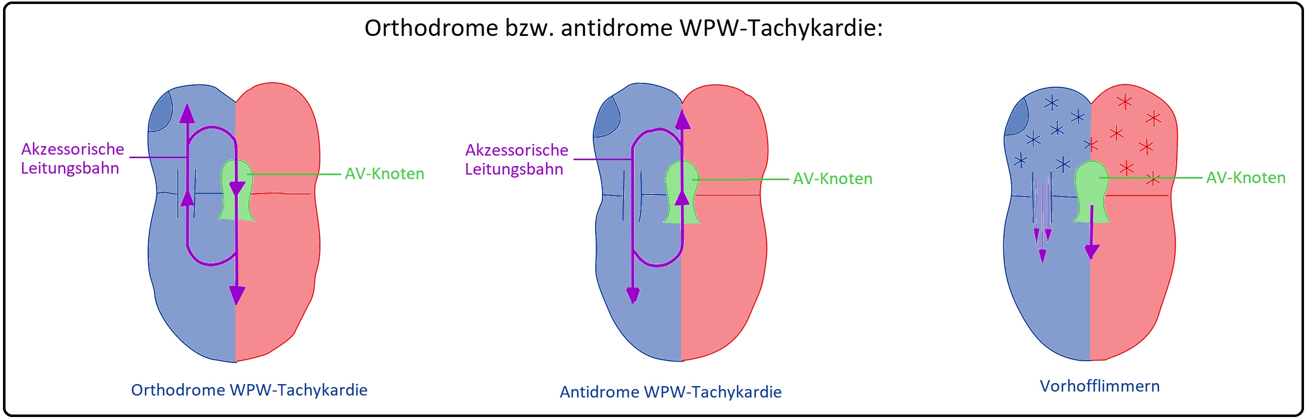 770 Orthodrome bzw. antidrome WPW Tachykardie