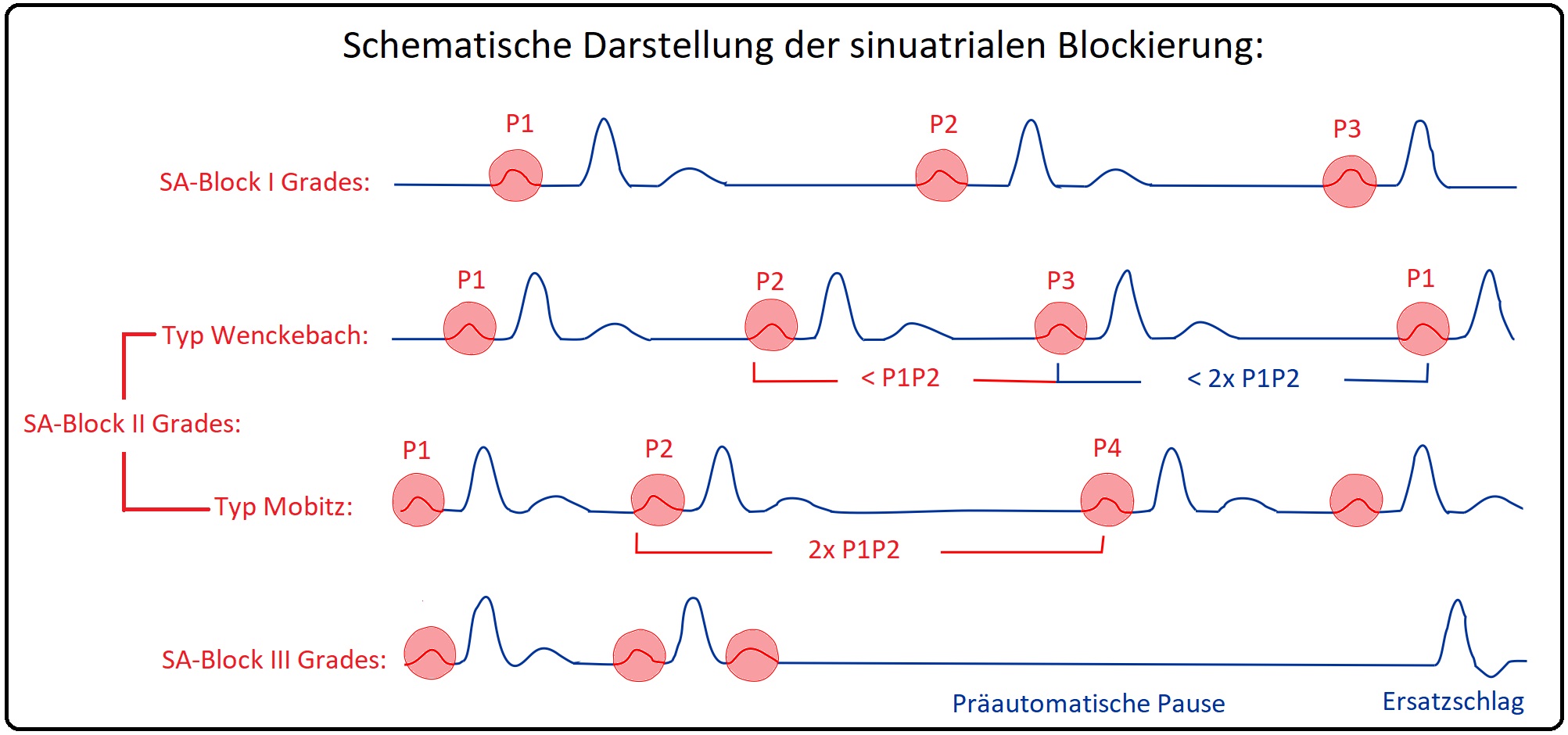 772 Schematische Darstellung der sinuatrialen Blockierung
