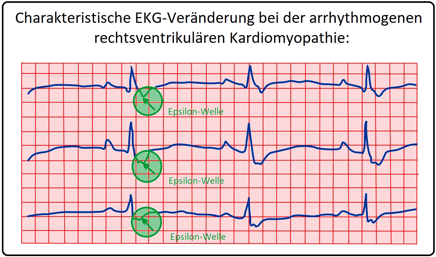 836 Charakteristische EKG Veränderung bei der arrhythmogenen rechtsventrikulären CM