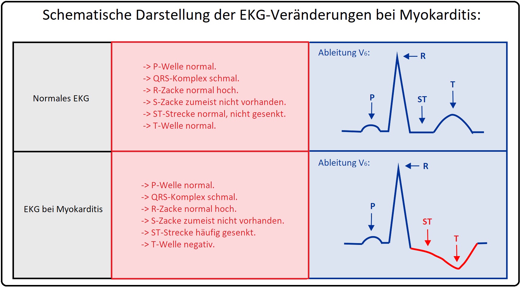 857 Schematische Darstellung der EKG  Veränderungen bei Myokarditis