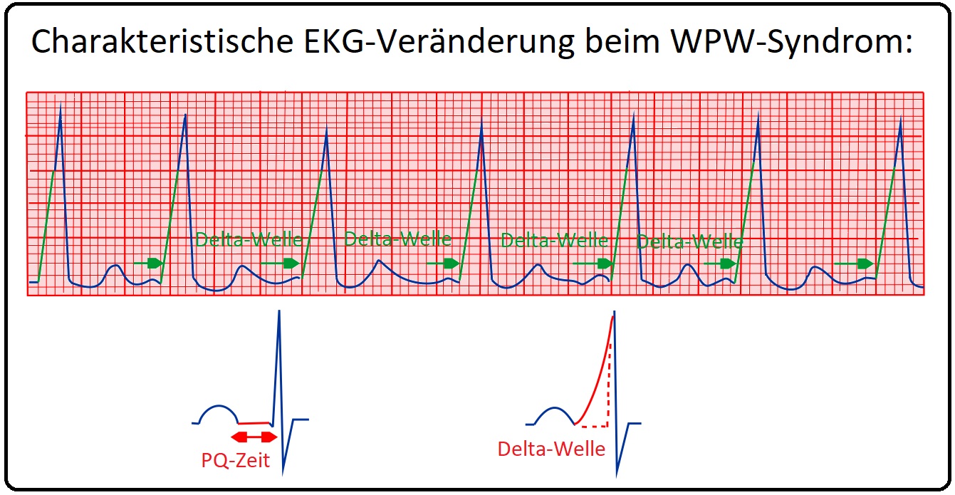 859 Charakteristische EKG Veränderung beim WPW Syndrom