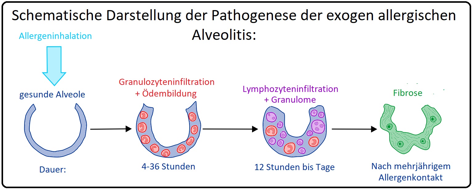 883 Schematische Darstellung der Pathogenese der exogen allergischen Alveolitis