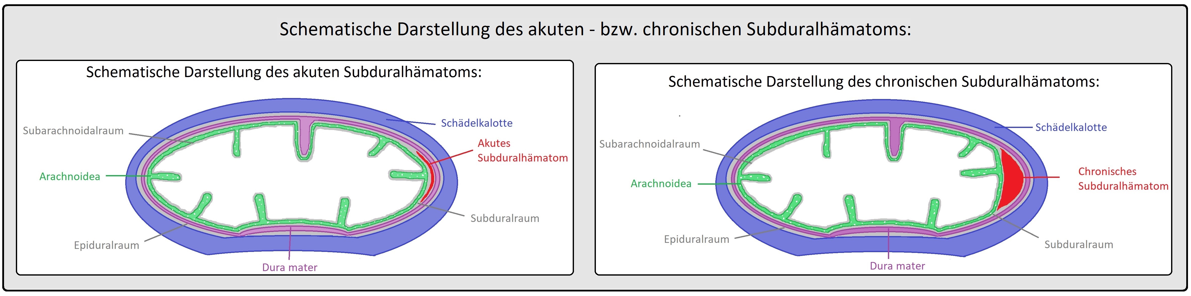 009 Schematische Darstellung des akuten   bzw. chronischen Subduralhämatoms