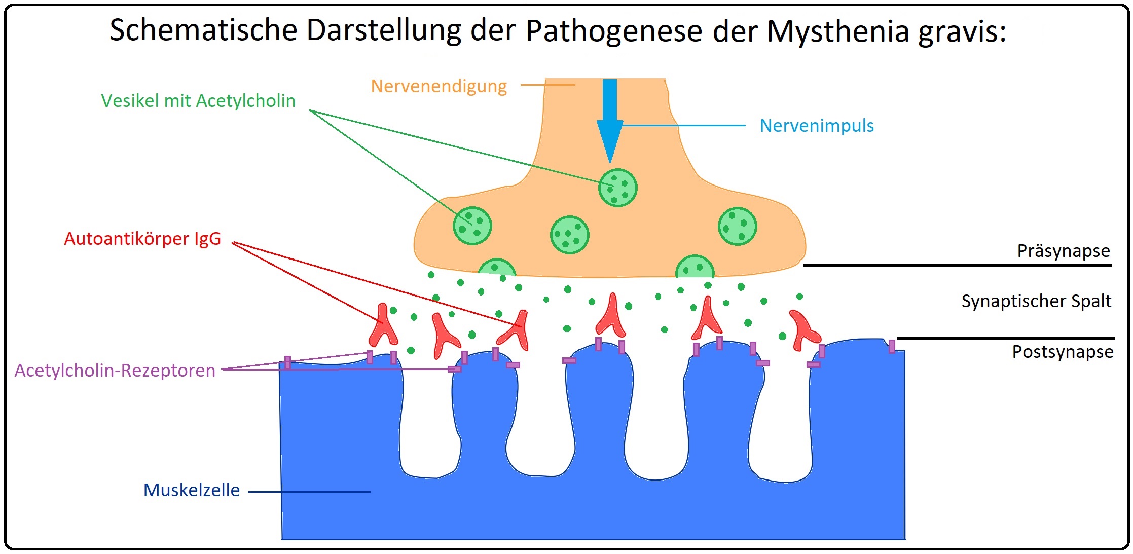 061 Schematische Darstellung der Pathogenese der Mysthenia gravis