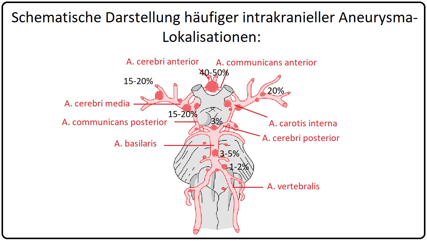 090 Schematische Darstellung häufiger intrakranieller Aneurysmalokalisationen