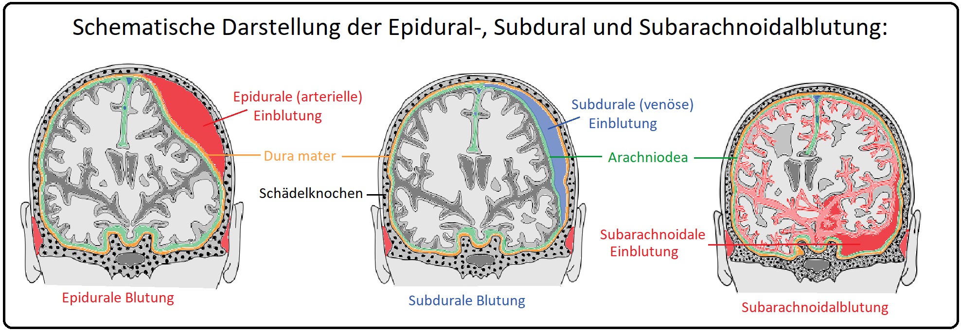 095 Schematische Darstellung der Epidural , Subdural  und Subarachnoidalblutung