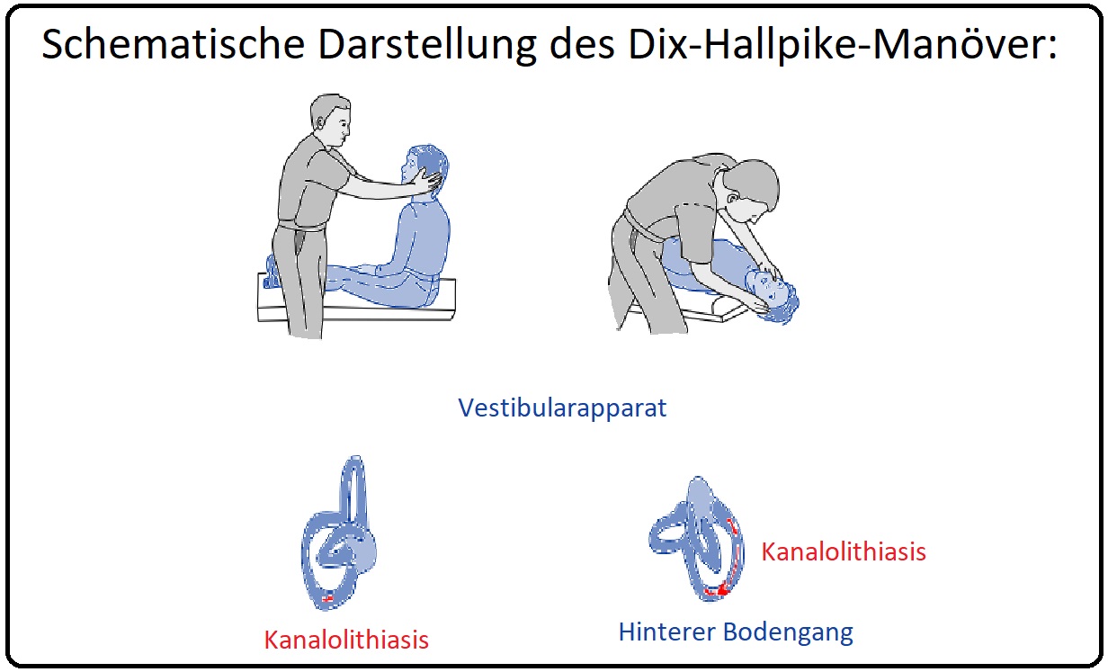 41 Schematische Darstellung des Dix Hallpike Manövers