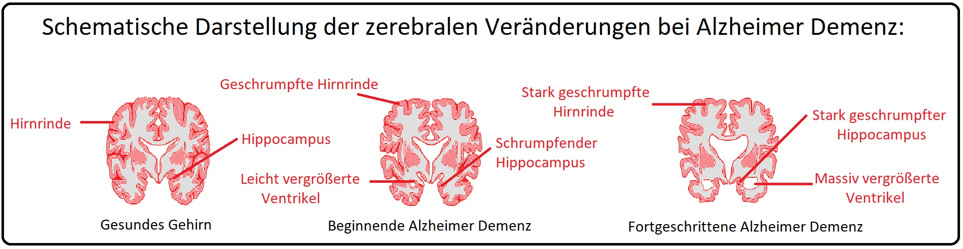 779 Schematische Darstellung der zerebralen Veränderungen bei Alzheimer Demenz