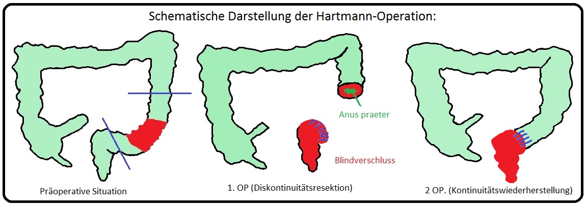 415 Schematische darstellung der Hartmann Operation