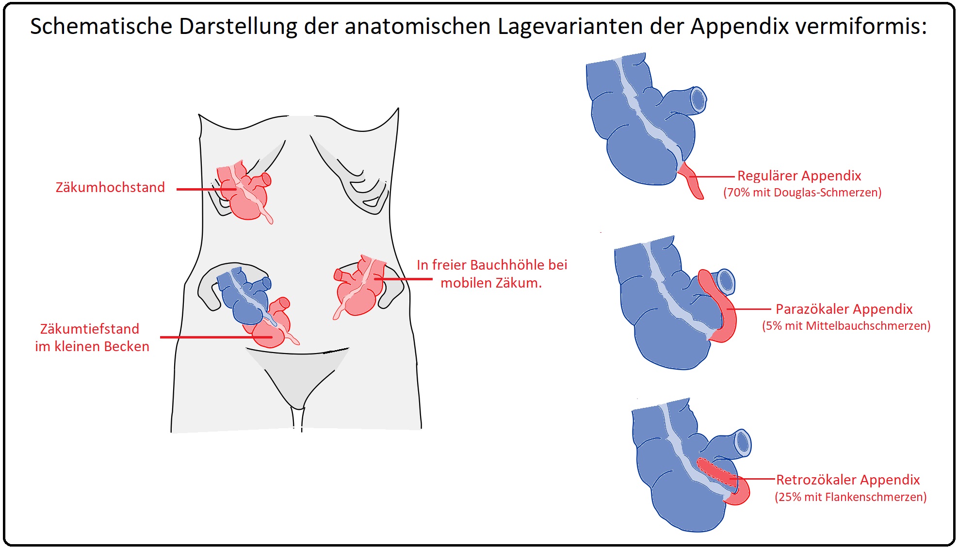 755 Schematische Darstellung der anatomischen Lagevarianten der Appendix vermiformis