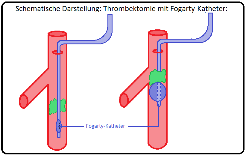 424 Schematische Darstellung Thrombektomie mit Fogarty Katheter