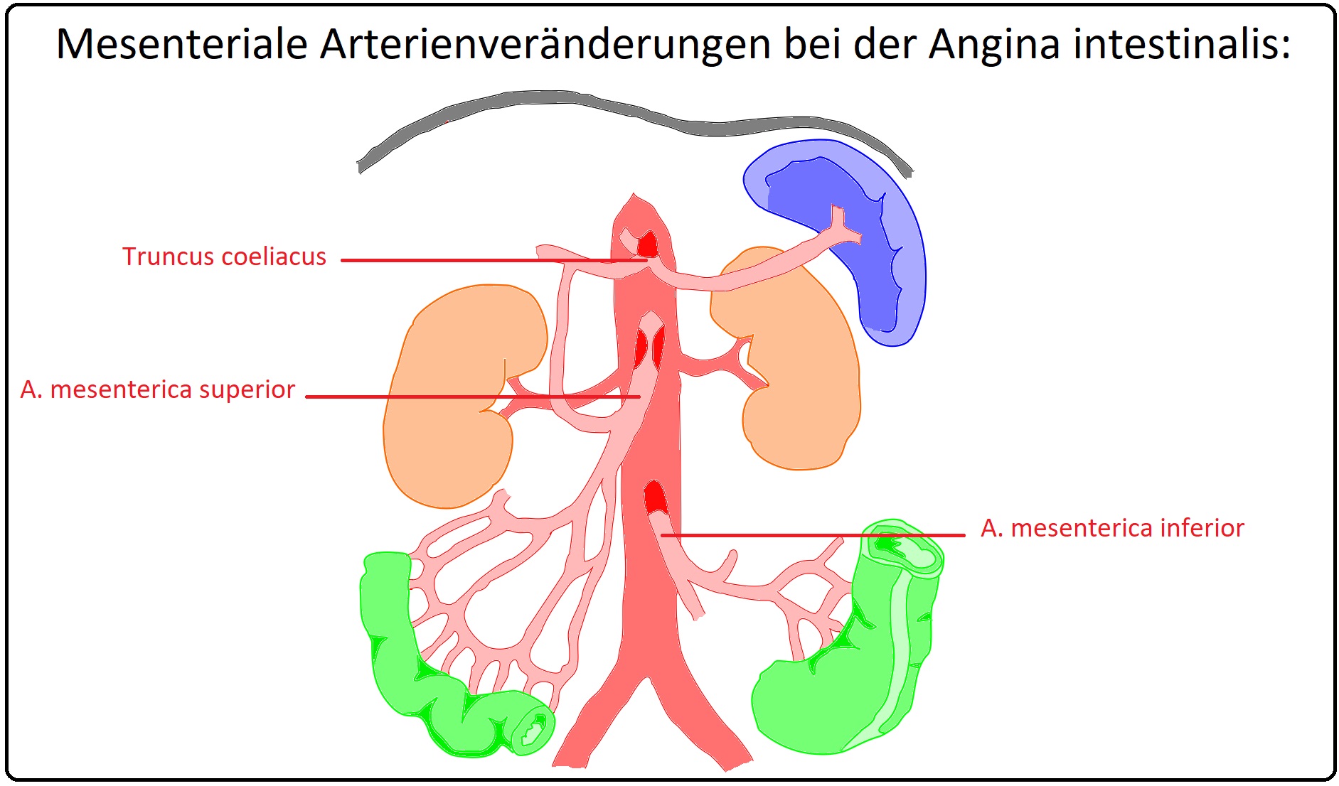 534 Mesenteriale Arterienveränderungen bei der Angina abdominalis
