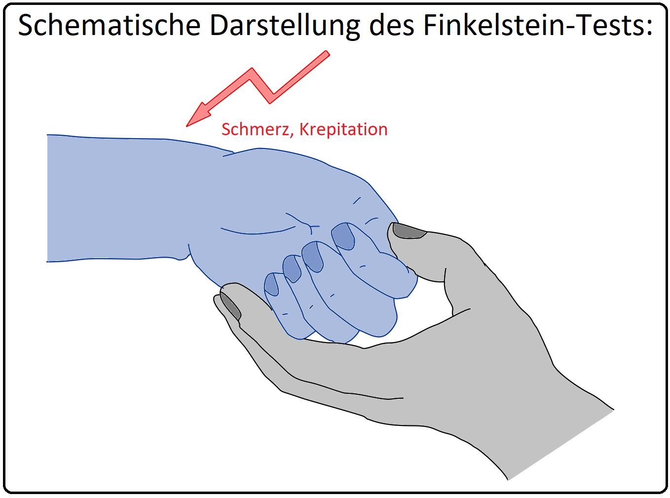 600 Schematische Darstellung des Finkelstein Tests
