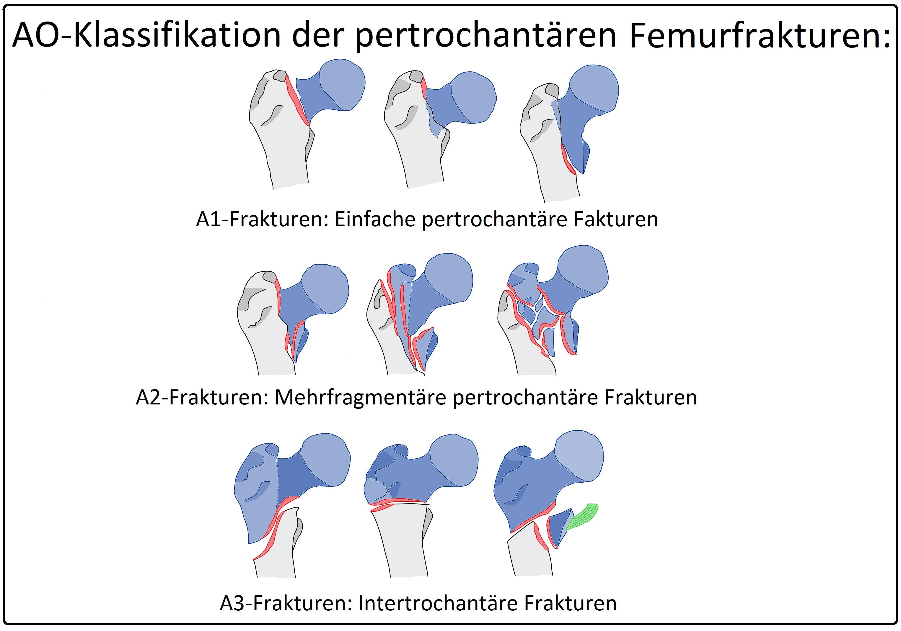 631 AO Klassifikation der pertrochantären Femurfrakturen