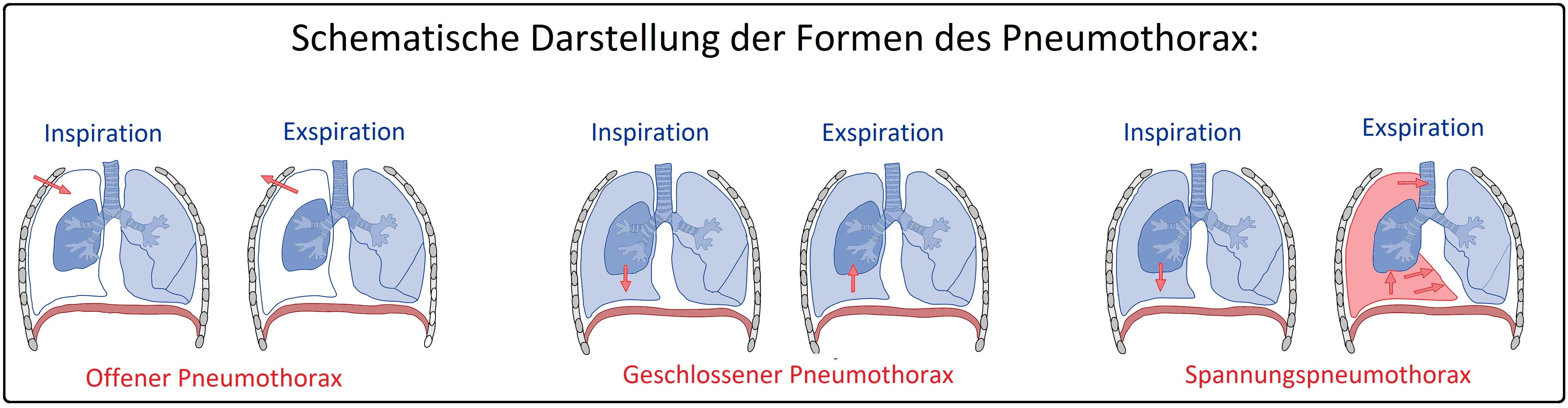 690 Schematische Darstellung der Formen des Pneumothorax
